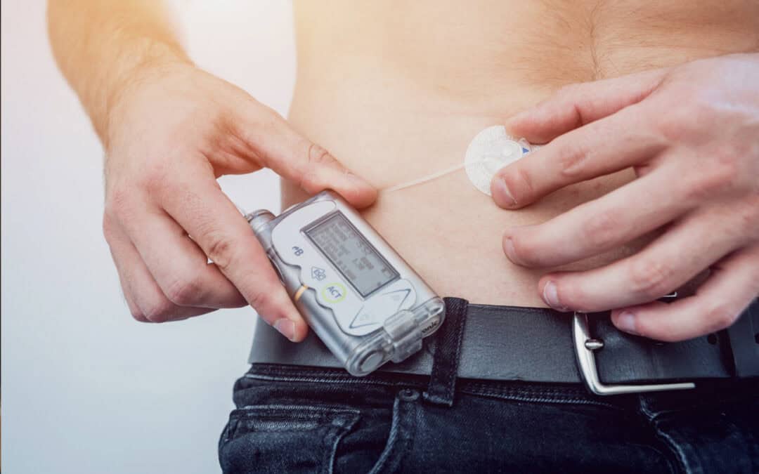 In 30 anni i microinfusori hanno ridotto la frequenza delle chetoacidosi
