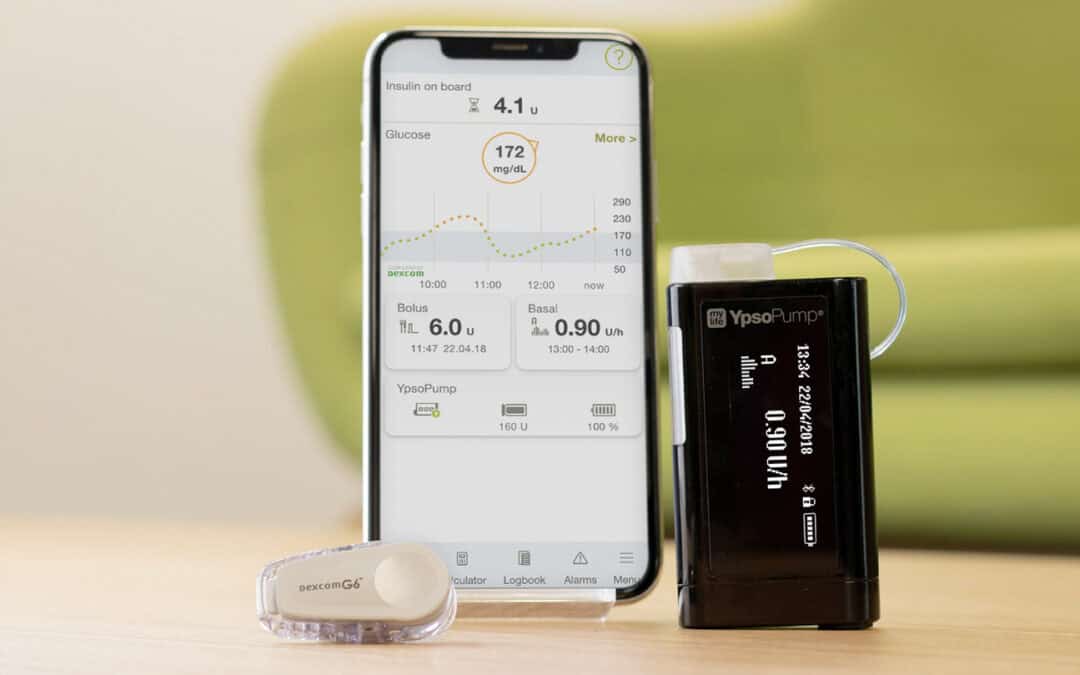 Successo del pancreas artificiale “open source”